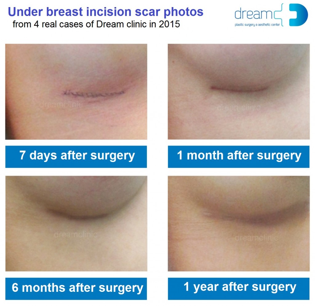 breast scar dream clinic