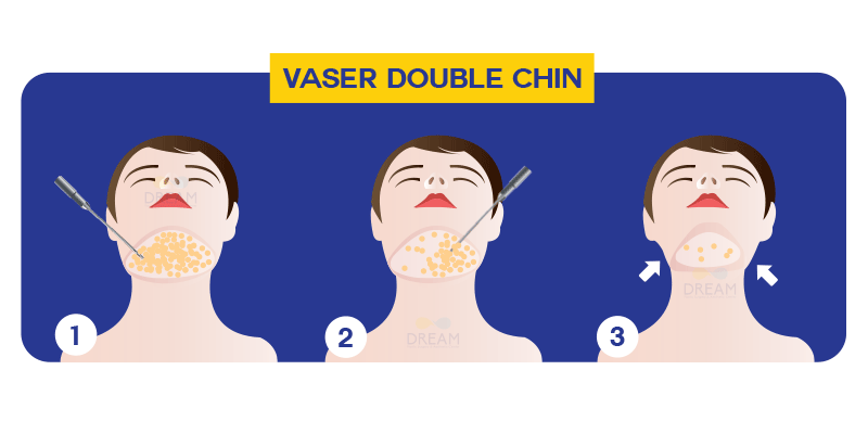 ดูดไขมันเวเซอร์เหนียง Vaser Double Chin, Vaser Cheek 