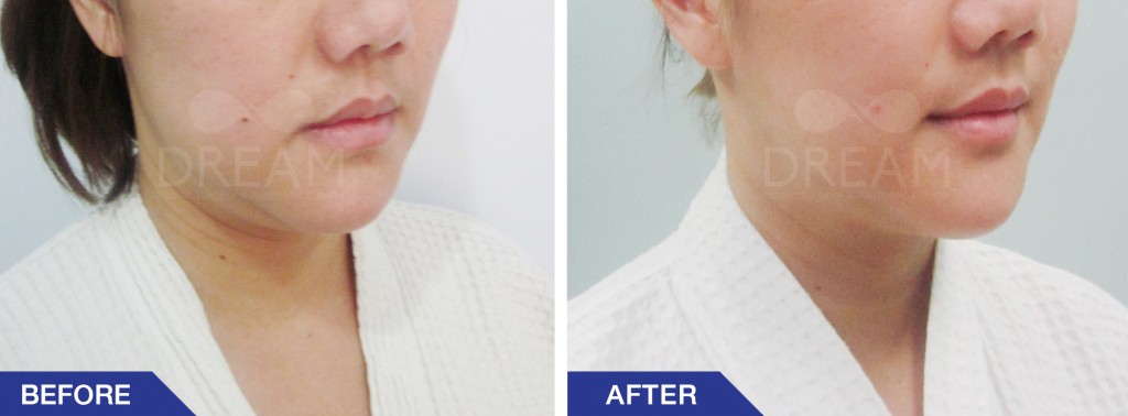 ดูดไขมันเวเซอร์เหนียง Vaser Double Chin, Vaser Cheek